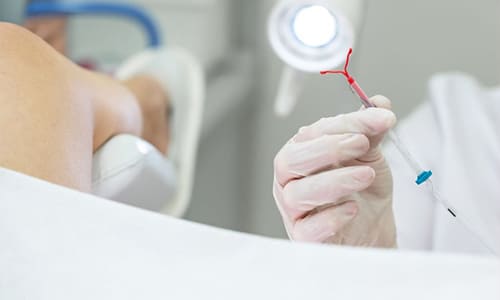 Métodos anticonceptivos